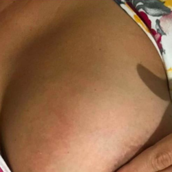 Mastitis Amamantar