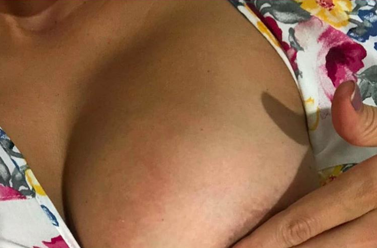 Mastitis Amamantar